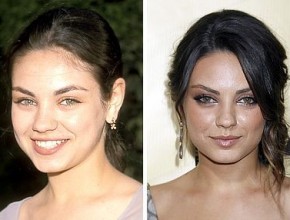 Mila Kunis before and after plastic surgery