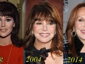 Marlo Thomas before and after plastic surgery