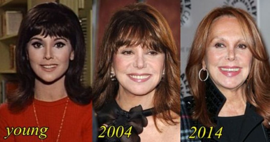 Marlo Thomas before and after plastic surgery.