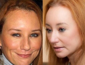 Tori Amos before and after plastic surgery