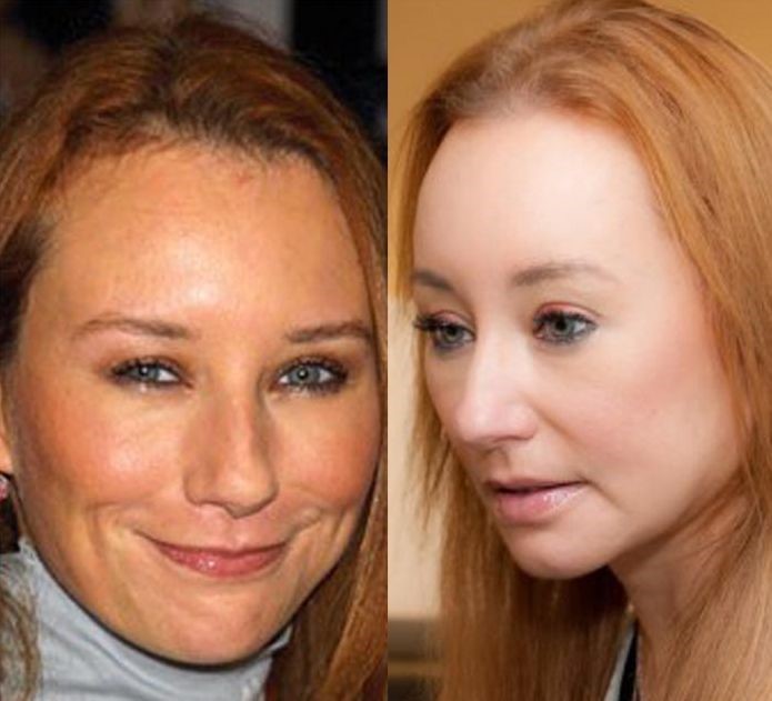 Tori Amos before and after plastic surgery.