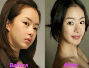 Seo Woo before and after plastic surgery