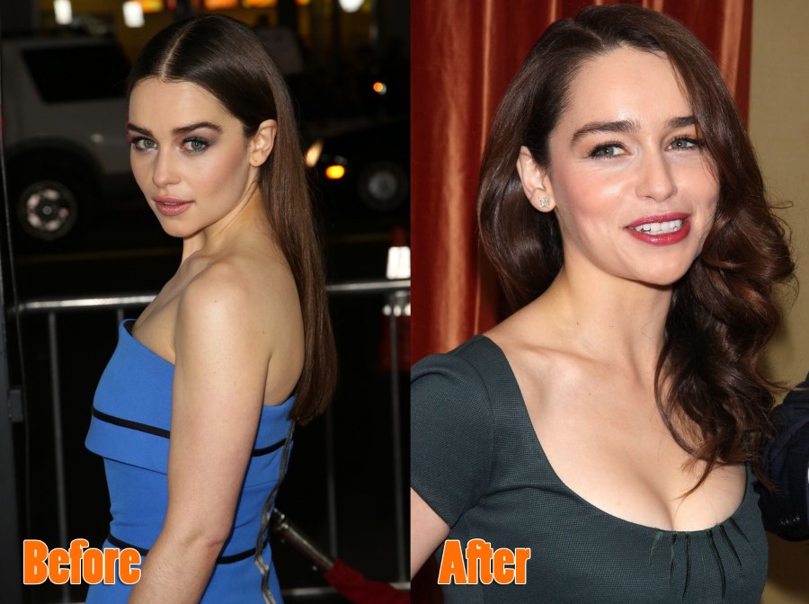 Emilia Clarke before and after plastic surgery