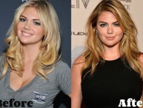Kate Upton before and after plastic surgery