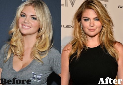 Kate Upton before and after plastic surgery