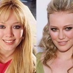 Hilary Duff Before and After Plastic Surgery