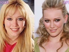 Hilary Duff Before and After Plastic Surgery