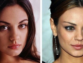 Mila Kunis before and after plastic surgery