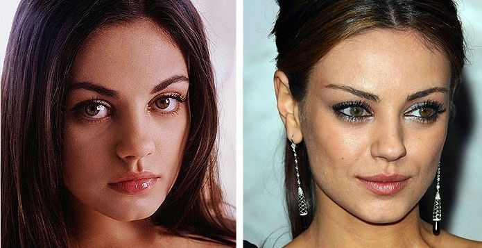 Mila Kunis before and after plastic surgery