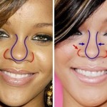 Rihanna before and after plastic surgery 117