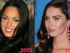 Megan Fox before and after plastic surgery