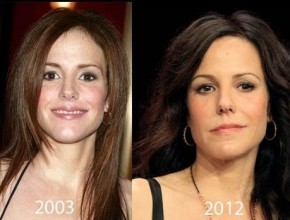 Mary Louise Parker before and after plastic surgery
