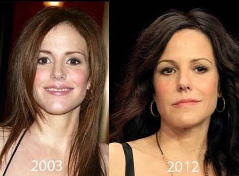 Mary Louise Parker before and after plastic surgery