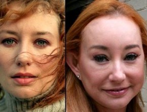 Tori Amos before and after plastic surgery