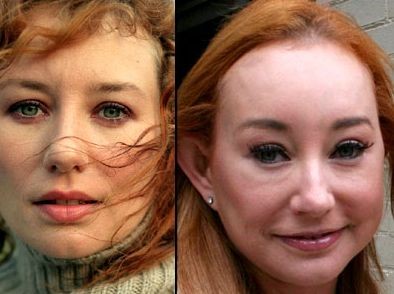 Tori Amos before and after plastic surgery