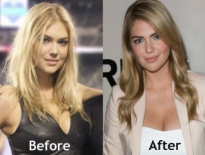 Kate Upton before and after plastic surgery