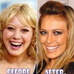 Hilary Duff Before and After Plastic Surgery