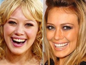 Hilary Duff Before and After Plastic Surgery