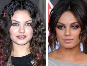 Mila Kunis before and after plastic surgery