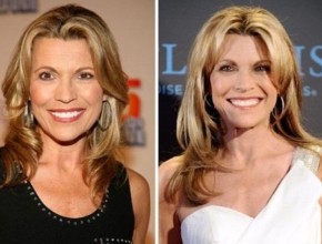 Vanna White before and after plastic surgery