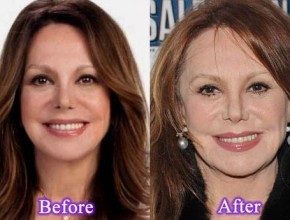 Marlo Thomas before and after plastic surgery