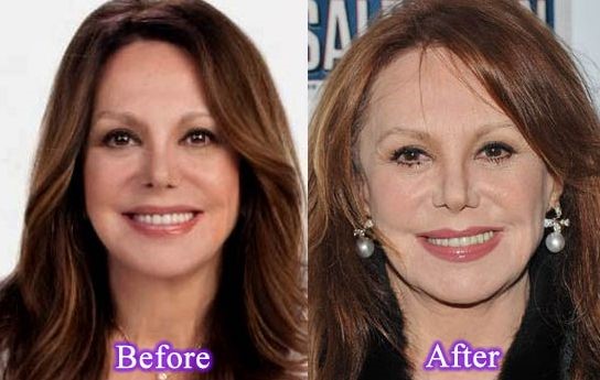 Marlo Thomas before and after plastic surgery