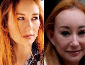 Tori Amos before and after plastic surgery