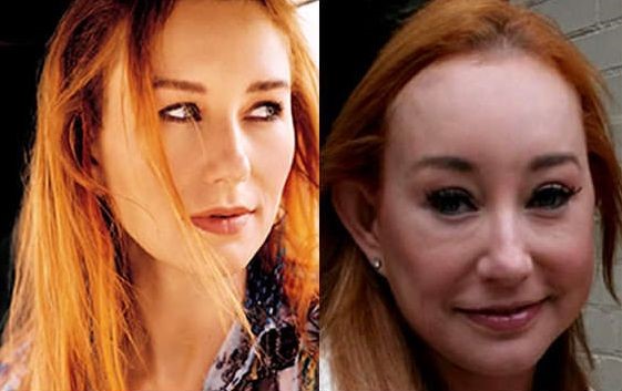 Tori Amos before and after plastic surgery