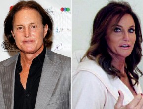 Caitlyn - Bruce Jenner before and after plastic surgery