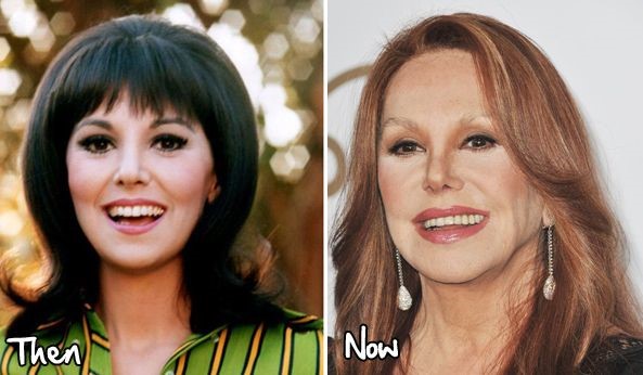 Marlo Thomas before and after plastic surgery