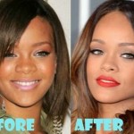 Rihanna before and after plastic surgery 410