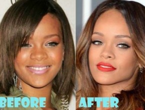 Rihanna before and after plastic surgery 410