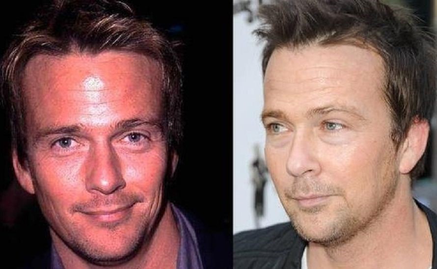 Sean Patrick Flanery before and after plastic surgery.