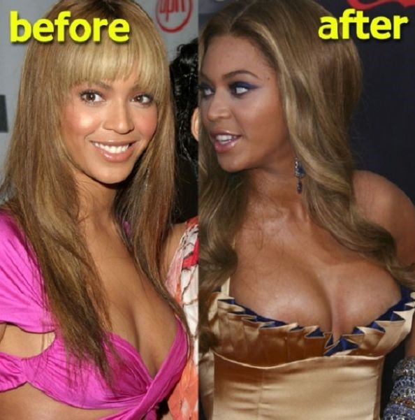 Beyonce before and after plastic surgery