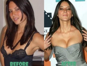Lisa Olivia Munn before and after plastic surgery