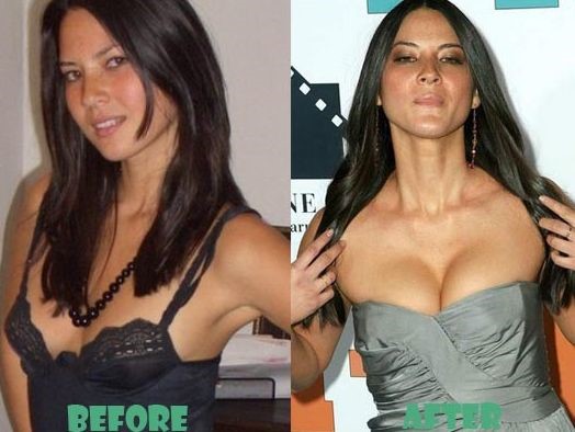 Lisa Olivia Munn before and after plastic surgery