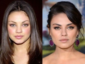 MIla Kunis before and after plastic surgery