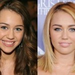 Miley Cyrus before and after plastic surgery