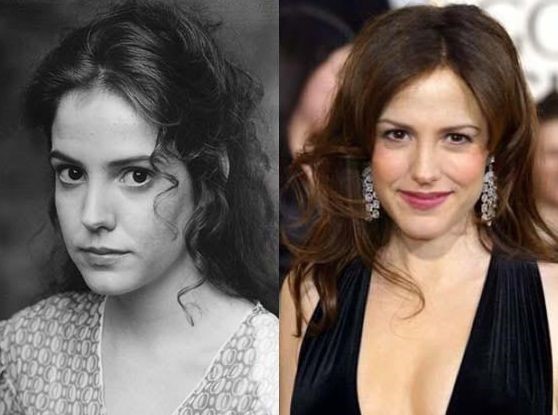Mary Louise Parker before and after plastic surgery