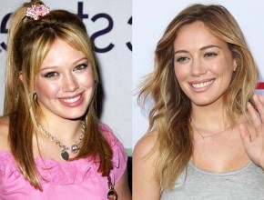 Hilary Duff Before and After Plastic Surgery