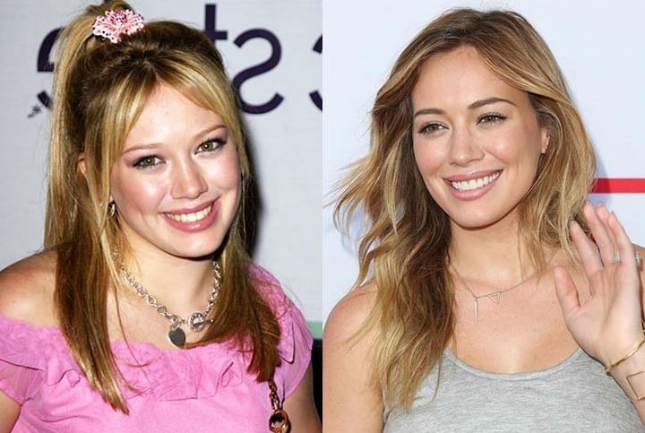 Hilary Duff Before and After Plastic Surgery