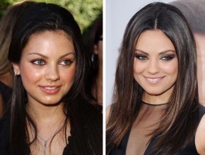 Mila Kunis before and after plastic surgery