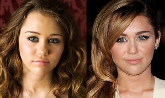 Miley Cyrus before and after plastic surgery