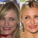 Cameron Diaz before and after plastic surgery 01