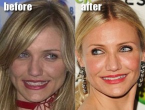 Cameron Diaz before and after plastic surgery 01