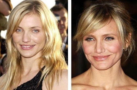 Cameron Diaz before and after plastic surgery