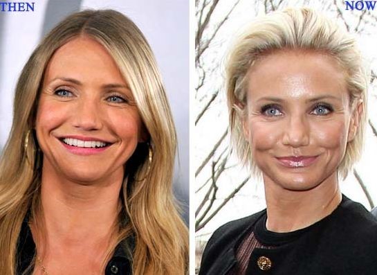 Cameron Diaz before and after plastic surgery