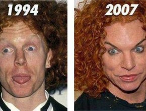 Carrot Top before and after plastic surgery 03