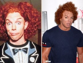 Carrot Top before and after plastic surgery 04