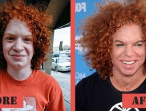 Carrot Top before and after plastic surgery